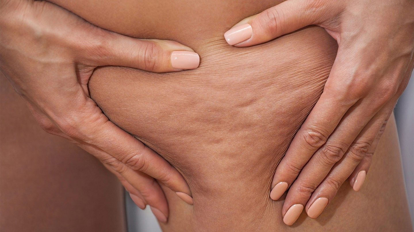 What Really Works For Cellulite Treatment?