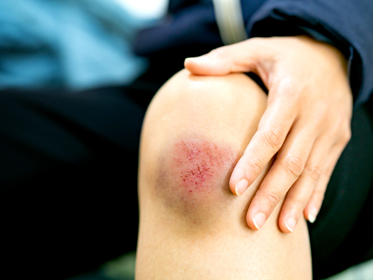 Contusion Of The Bone: Symptoms And Treatments  