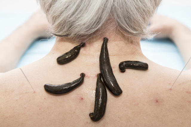 Is Leech Therapy Effective? Let's Talk About It