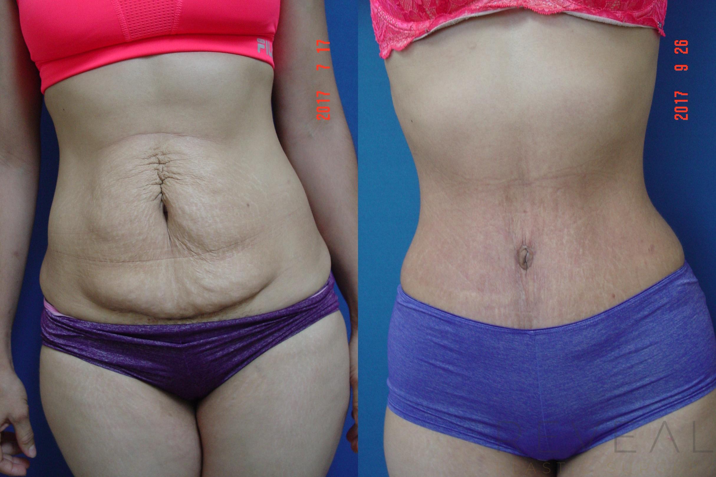 Signs that a tummy tuck procedure has  gone wrong 2023
